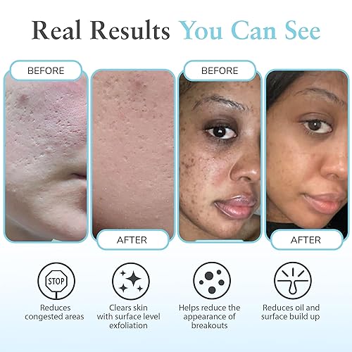 Miniatura 4 de Salicylic 10% Gel Peel, Breakout and Pore Minimizer and Cleanser, 15-30 Full Facial Chemical Peels, 1 fl oz. e, 30 mL – Perfect Image 10% de fuerza