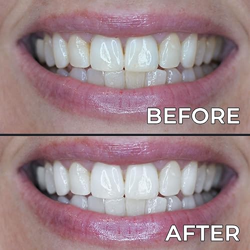 Miniatura 6 de PerioSciences Sistema de blanqueamiento dental  LED Dispositivo de luz de blanqueamiento dental inalámbrico  3 dientes blanqueamiento de gel pluma