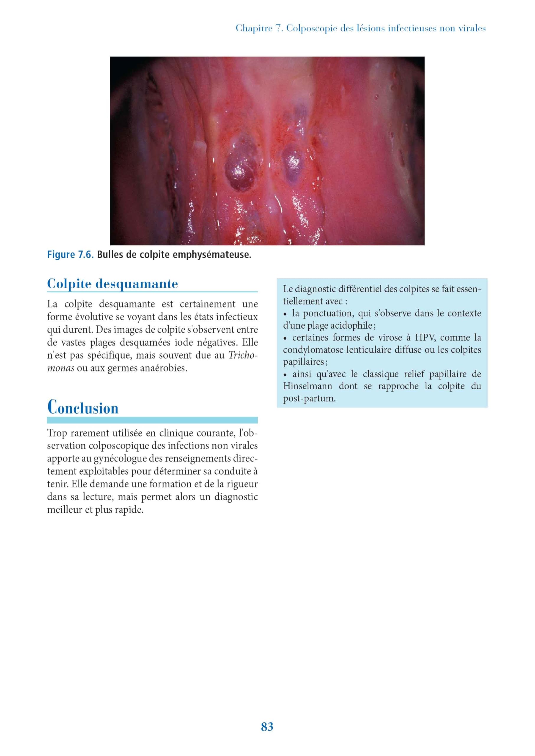 La colposcopie: Techniques et diagnostics