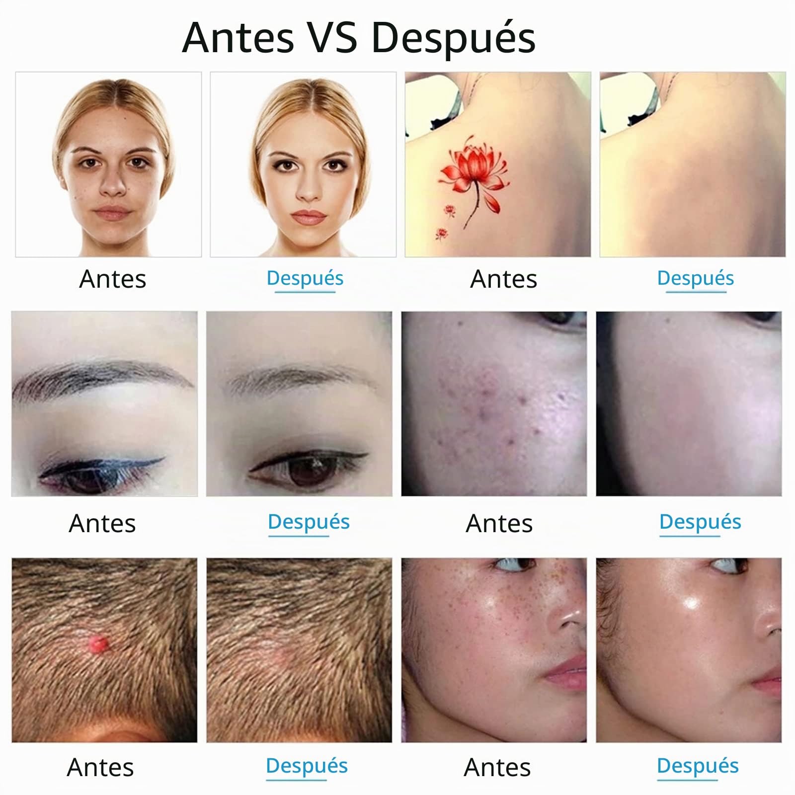 Pluma De Picosegundo, Máquina para Eliminar Manchas Lunares Equipo De Belleza Láser Eliminación De Tatuajes con Cicatrices De Pecas