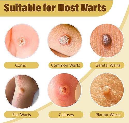 Miniatura 3 de SUVNUFK Removedor de verrugas de veneno de abeja, congelación de verrugas de acción rápida con 12% de ácido salicílico, removedor líquido de marcas