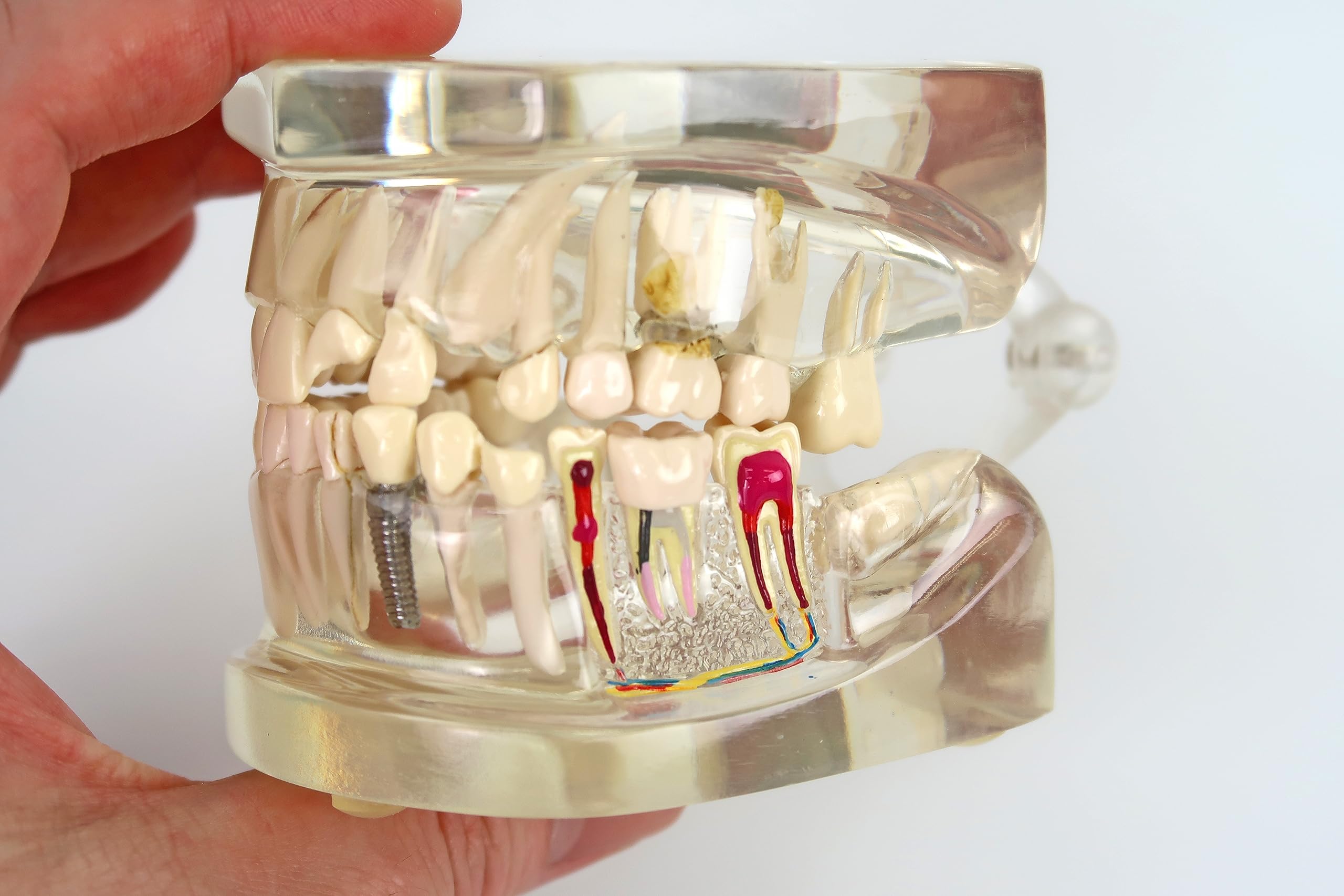 透明歯牙疾患模型