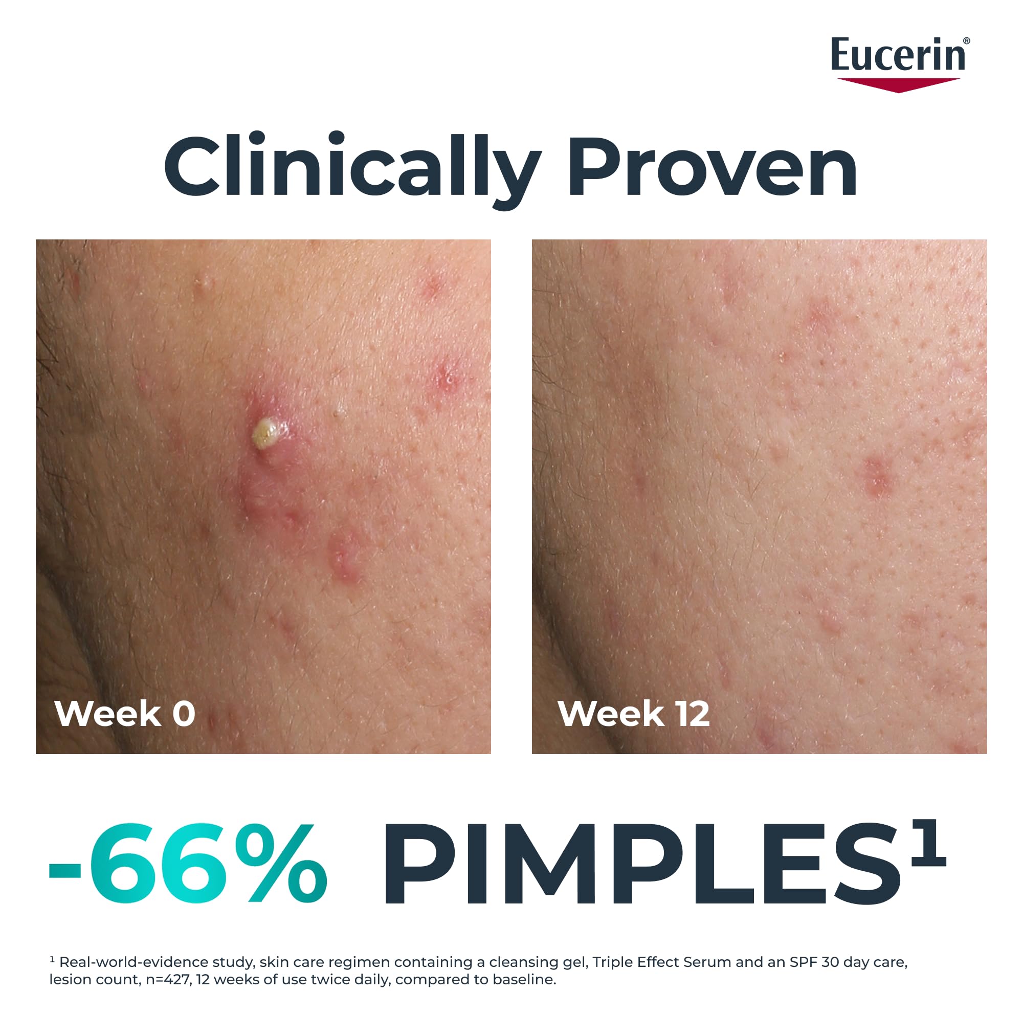 Eucerin Dermopure Clinical Triple Action Fluid 40ml, Acne Cream Serum with Salicylic Acid & Thiamidol - Image 2