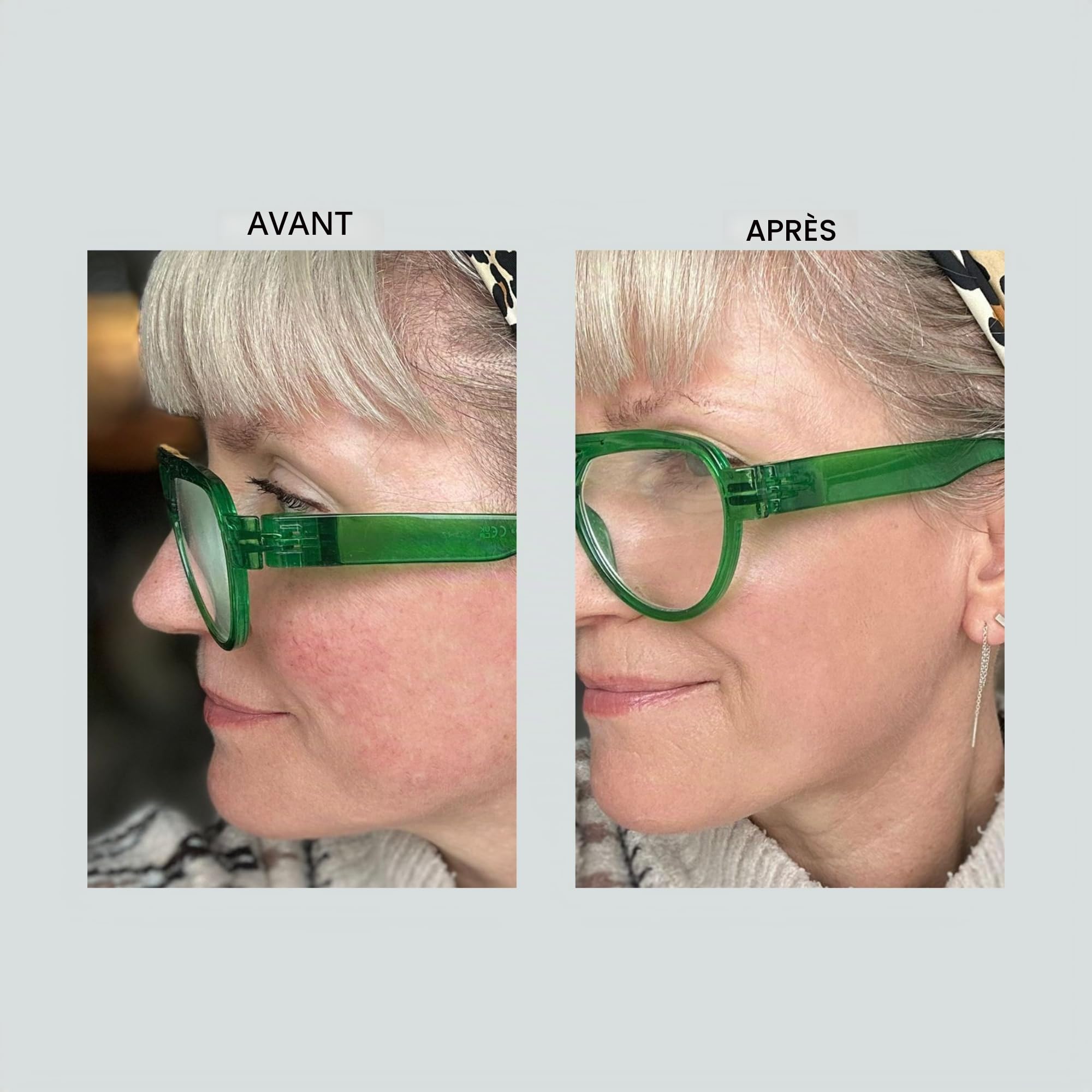 Altruist Dermatologist Crème hydratante anti-rougeurs et taches pigmentaires SPF 50 SPF 50 Protection UVA 5 étoiles Crème visage non parfumée pour peaux sensibles – Pour tous les types de peau 30 ml