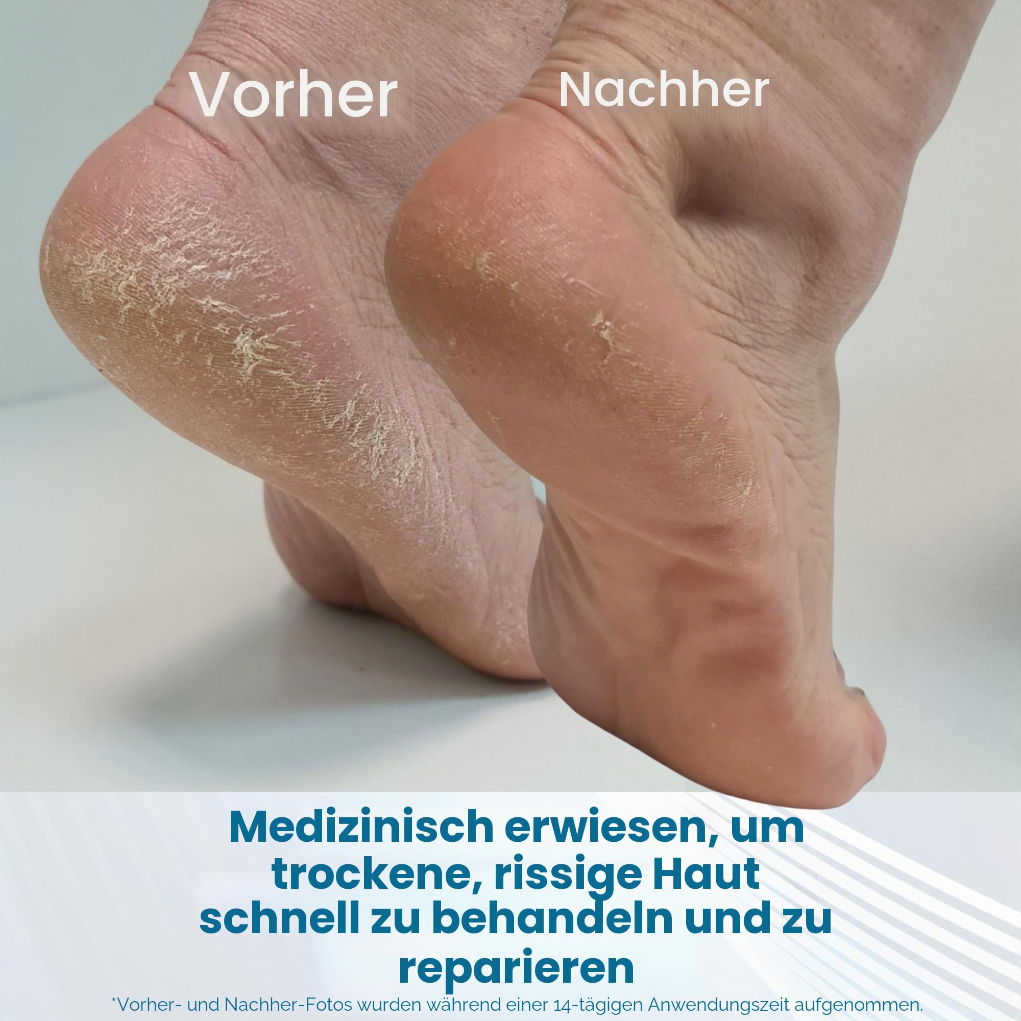 Flexitol Rissiger Fersenbalsam, Sichtbare Ergebnisse in 1 Tag, Für extrem trockene Füße & rissige Fersen, Entfernt harte Haut, 25% Urea, medizinisch bewährte Fußcreme, Diabetiker geeignet, 1 x 56 g