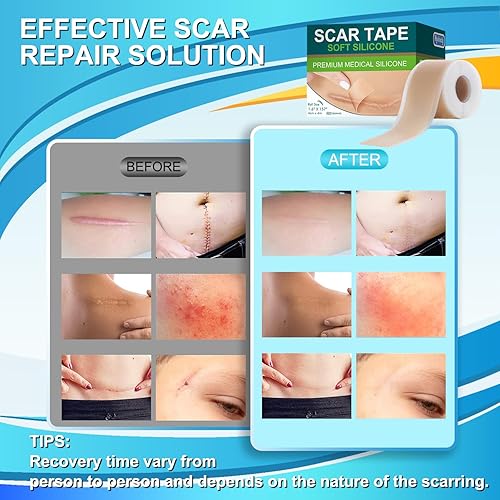Miniatura 5 de Cinta de silicona de grado médico para cicatrices quirúrgicas (1.6 pulgadas x 157 pulgadas - 13.1 ft), hojas de silicona profesional para cicatrices