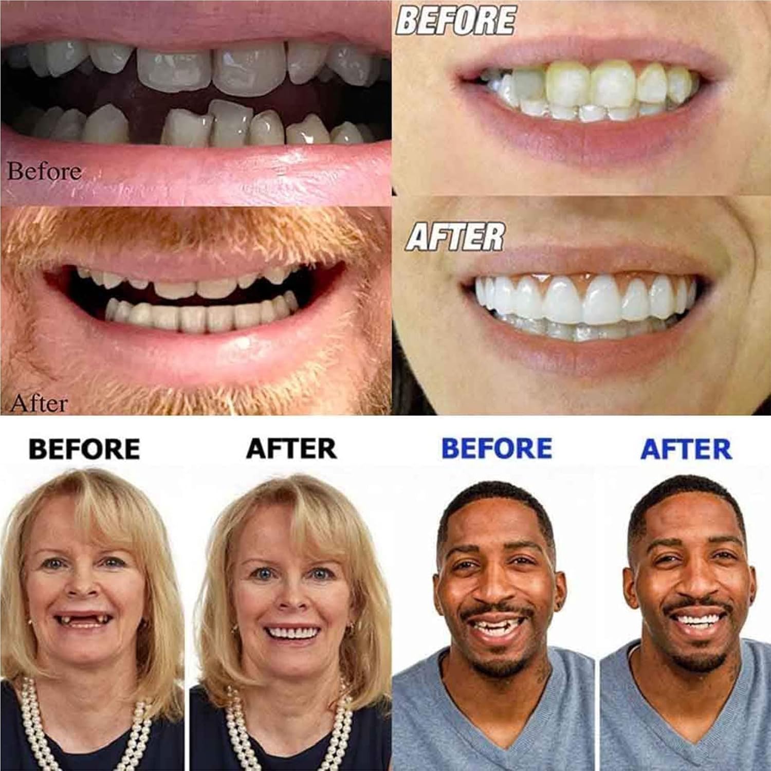 Generico Faccette Dentali, Faccette in Silicone per Protesi Dentarie | Si Ammorbidisce A Contatto Con Lacqua E Può Essere Riutilizzato; Offre Una Copertura Naturale E Realistica (9pcs)