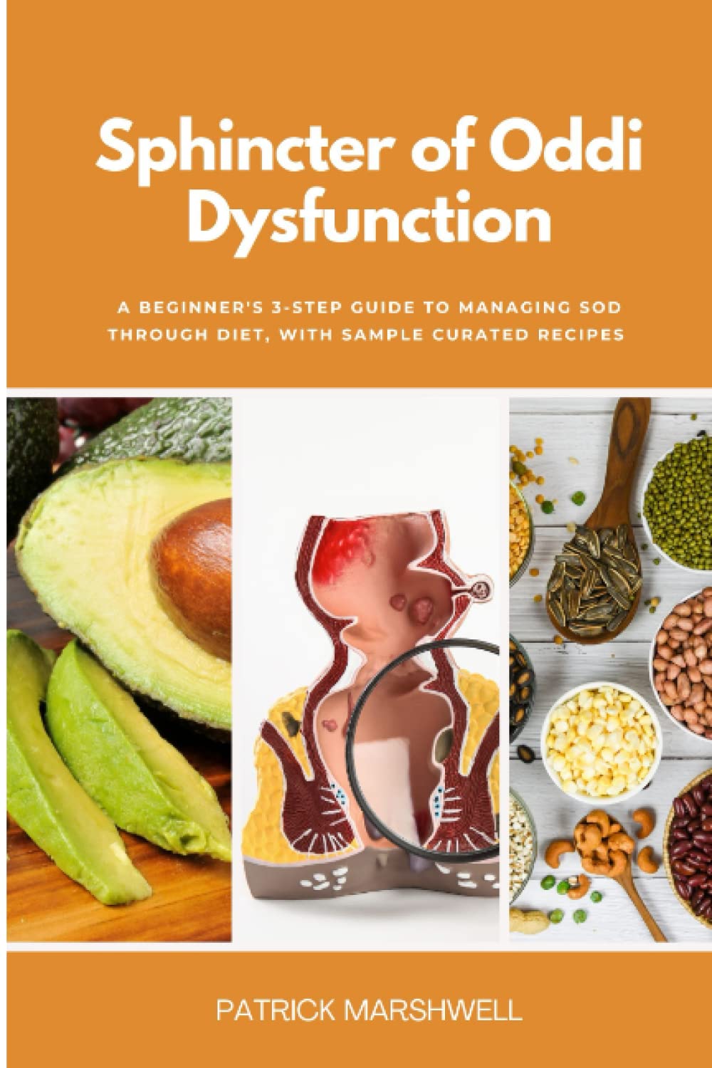 Sphincter of Oddi Dysfunction: A Beginner's 3-Step Guide to Managing SOD Through Diet, With Sample Curated Recipes