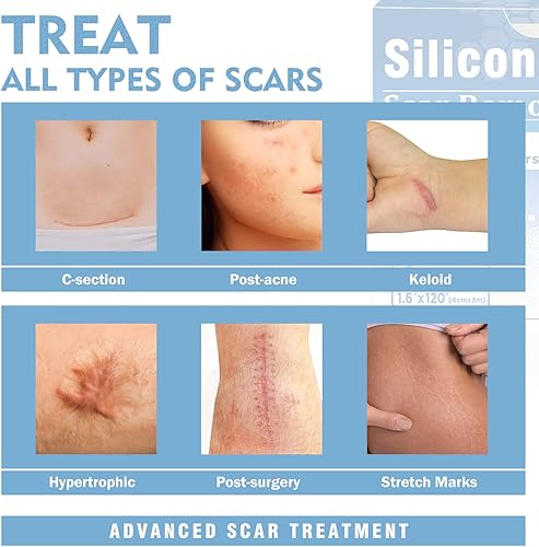 Miniatura 9 de Carbou Hojas de silicona para cicatrices rollo de 16 x 60 pulgadas rollo de cinta de silicona suave fácil de rasgar para eliminar cicatrices hojas