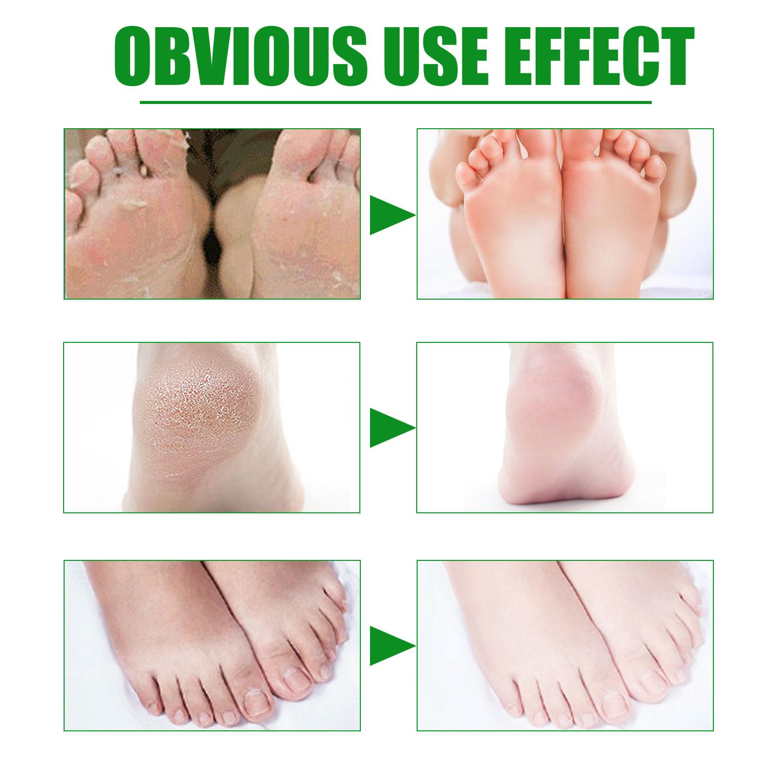 3 works Foot Peel Mask, Aloe Vera Exfoliating Foot Peel Mask, Foot Mask Peel for Dry Cracked Heels & Calluses - Image 4