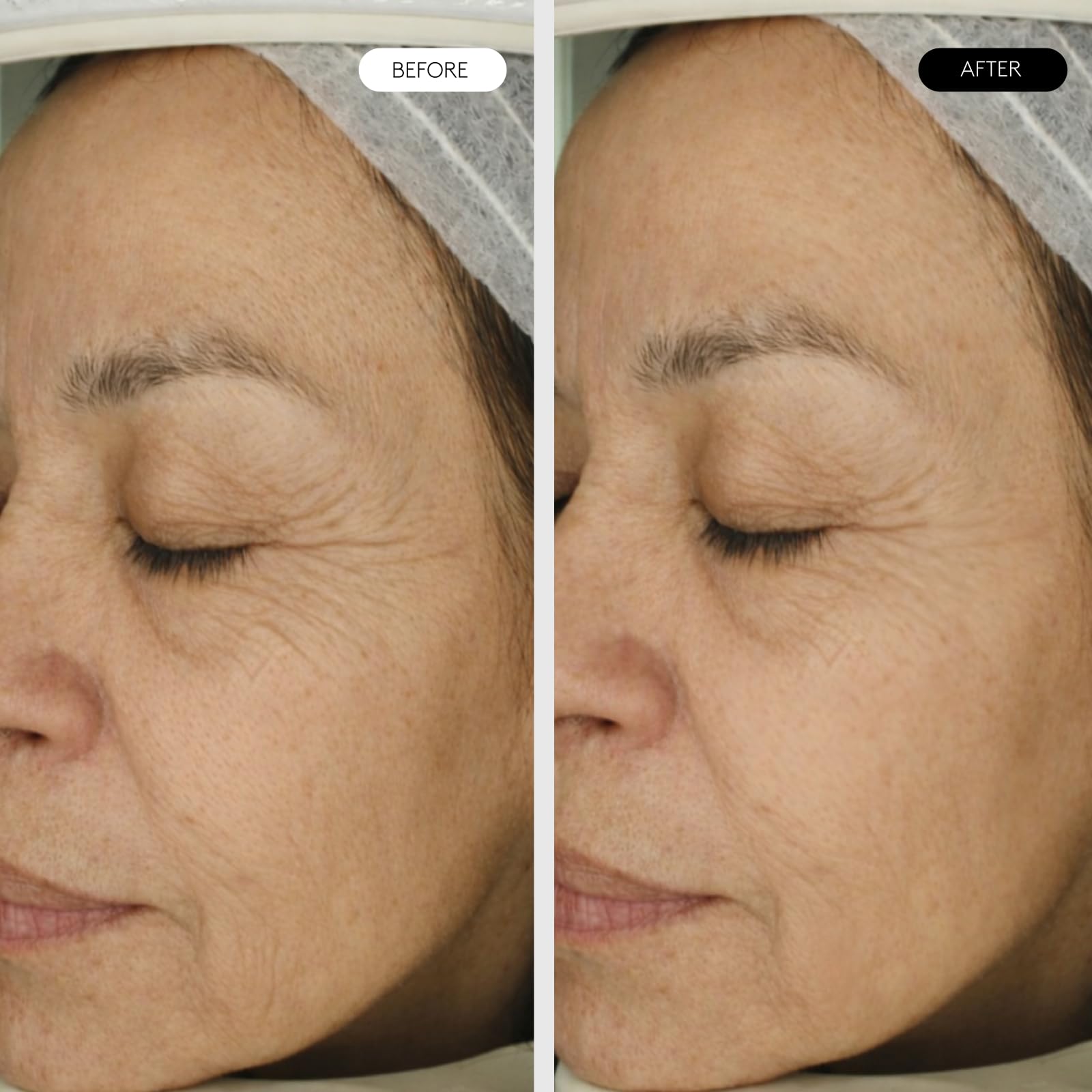 CLINICAL BEAUTY FILLER – Anti-Falten-Behandlung – 1 Anwendung – Fortschrittliche Technologie – Bekämpft Hauterschlaffung – Einfach, Schmerzfrei und Sicher – Mit Hyaluronsäure und Peptiden | Mit Hyaluronsäure, Matrixyl und Argireline, straffend, reduziert