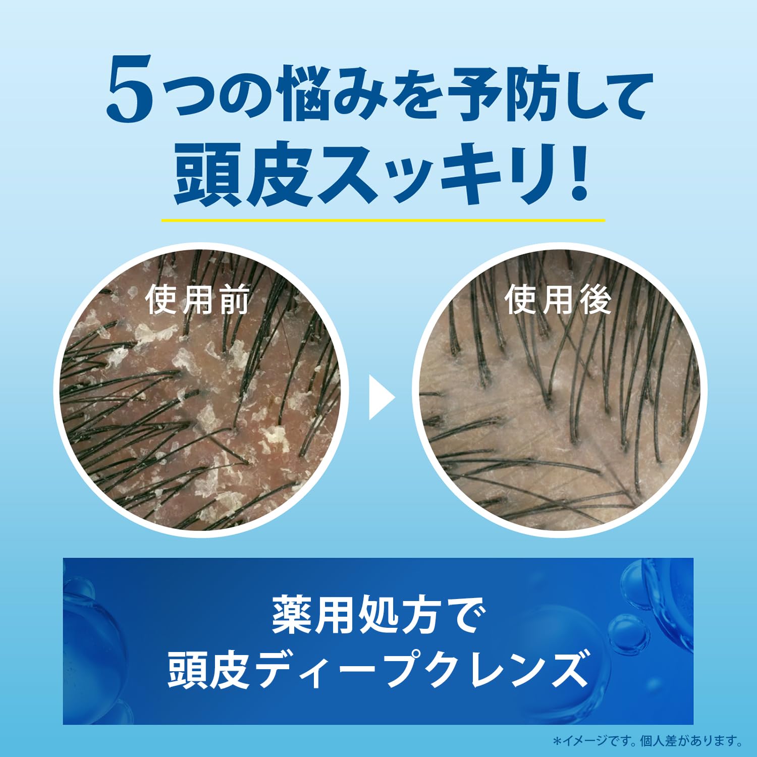 Amazon.co.jp: h&s 5in1 [かゆみ・フケ・頭皮悩み] コンディショナー