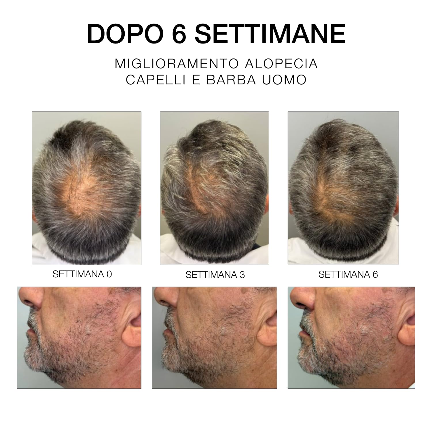 Diego dalla Palma ESTREMIRIMEDI Siero 6, Trattamento Fortificante Scalpo e Capelli, Stimolante del Microcircolo, Rinforzante della Fibra Capillare, 50ml