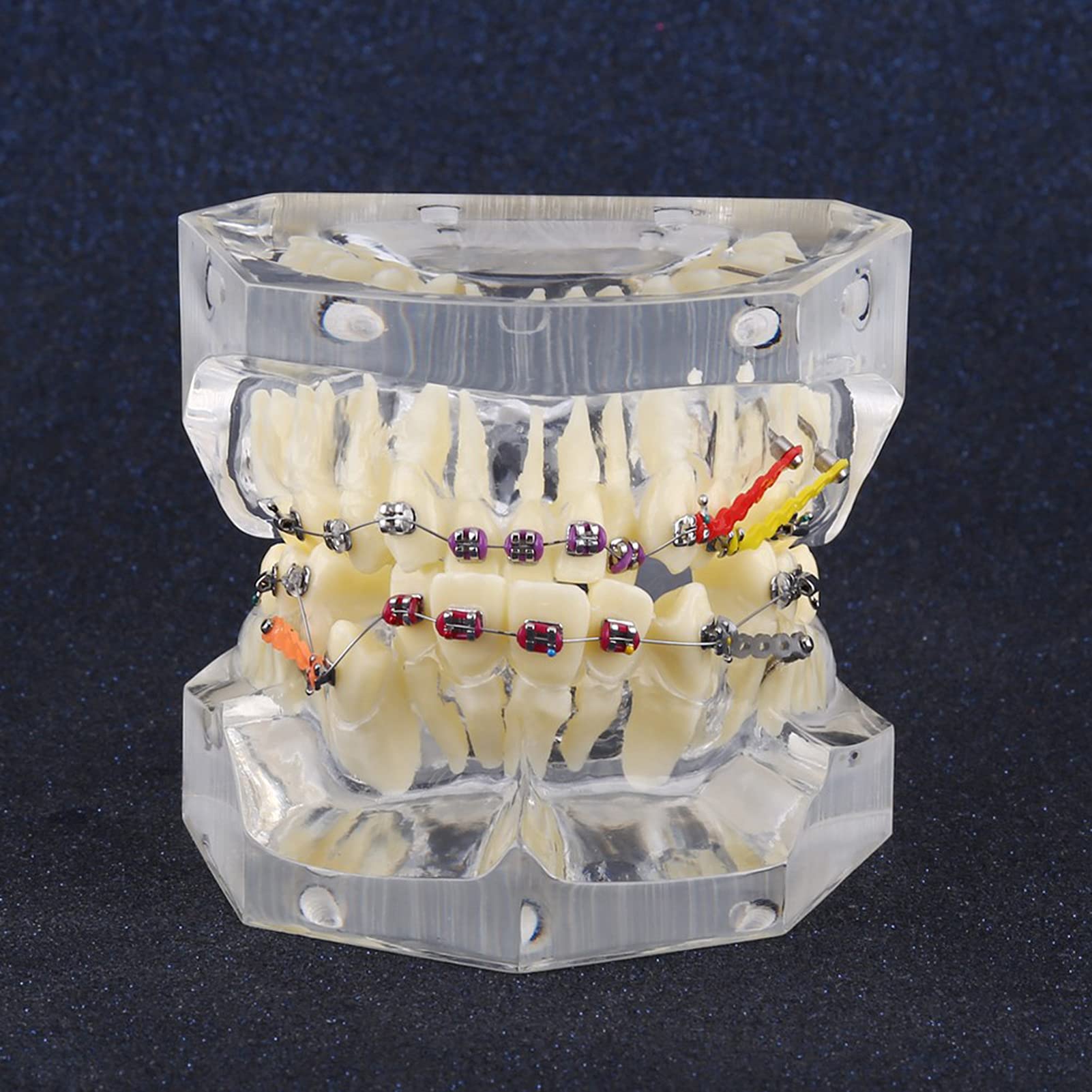 Staffe Ortodontiche, Modello di Denti Trattamento Ortodontico Dentale Studio di Malocclusione Modello di Denti con Staffe Dentali a Catena Metallica