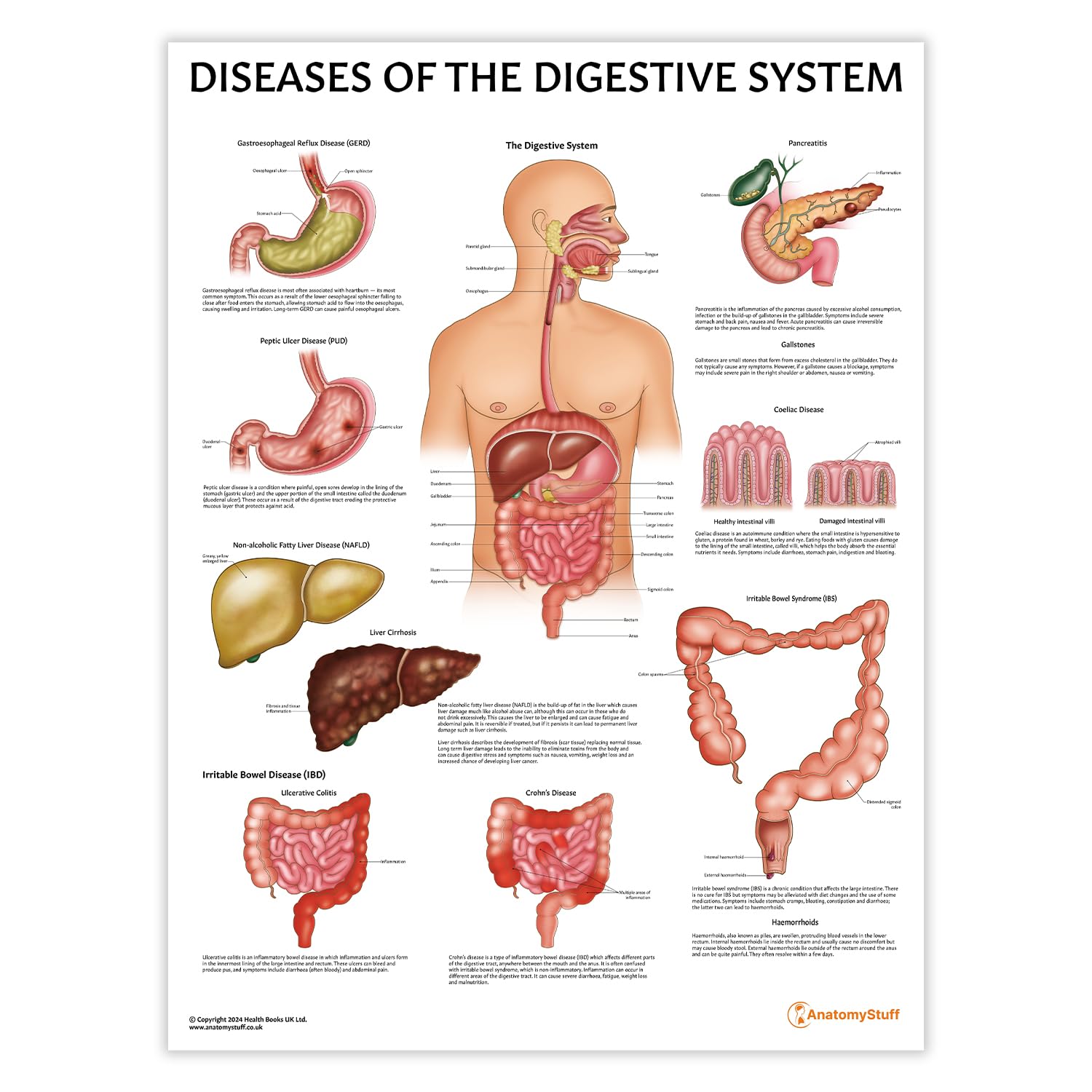 Anatomy Stuff Digestive System Pathology Anatomystuff Diseases Of The Digestive System Poster/Chart 45X60cm, 18X24 Inches, Digestive System Anatomy, Gastroenterology Diagram