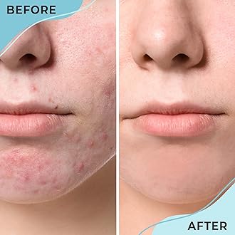 AYADARA Cystic Hormonal & Severe Acne Spot Treatment for Face | Overnight Cystic Acne Treatment for Teens, Women, & Men with Sensitive Skin | Blind Pimple & Blemish Remover Cream | 120+ Treatments