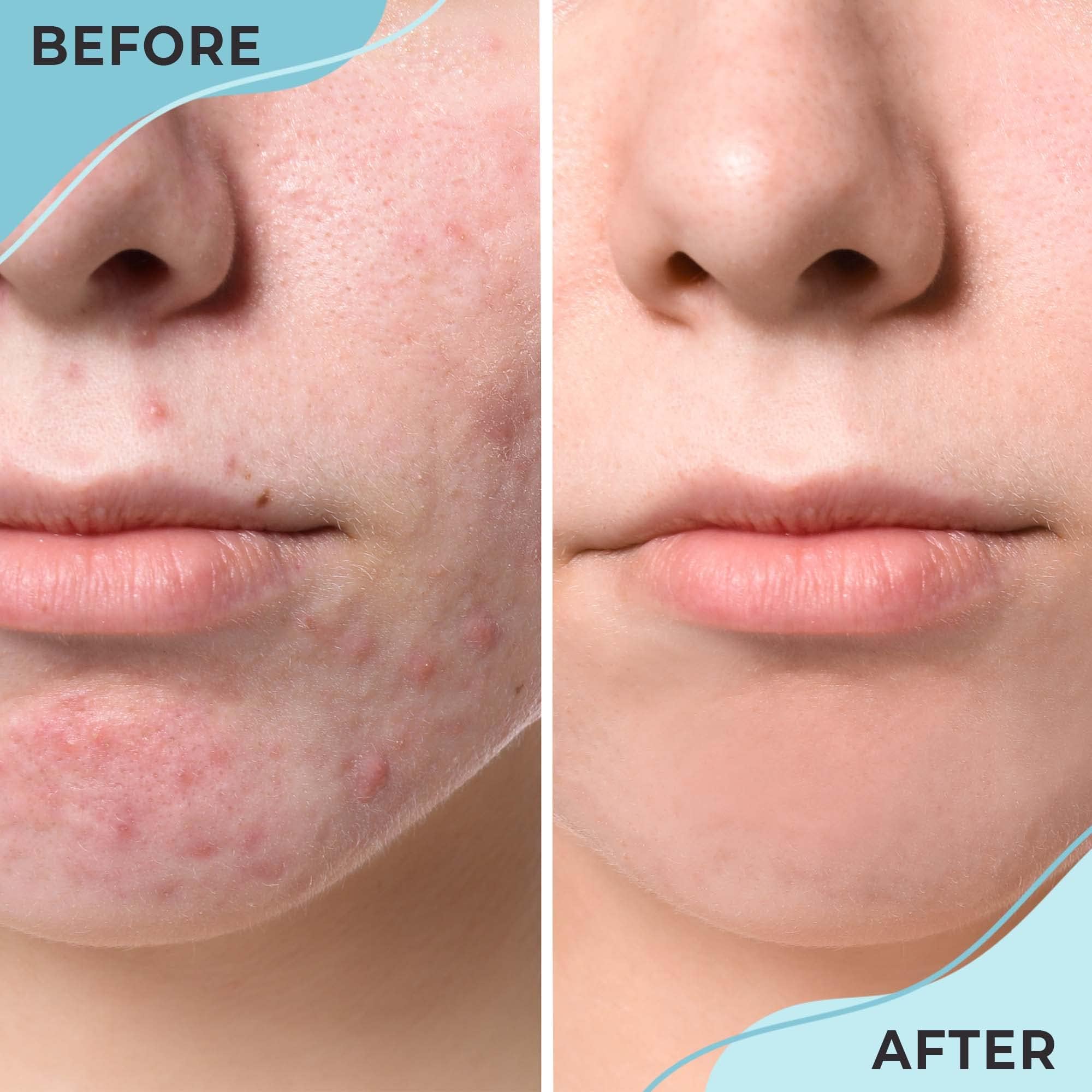 Cystic Hormonal & Severe Acne Spot Treatment for Face | Overnight Cystic Acne Treatment for Teens, Women, & Men with Sensitive Skin | Blind Pimple & Blemish Remover Cream | 120+ Treatments