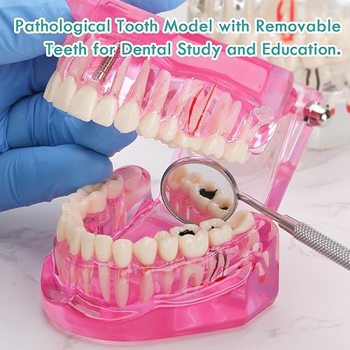 Miniatura 7 de Modelo de dientes de implante dental transparente - Modelo de dientes de enfermedad transparente Modelo de dientes patológicos con dientes