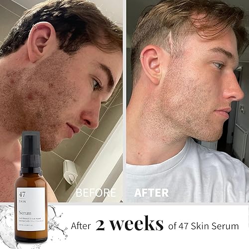 Miniatura 6 de Suero facial hidratante para eliminar el acné y las cicatrices, suero antimanchas y reparación de cicatrices, tratamiento para el cuidado de la piel