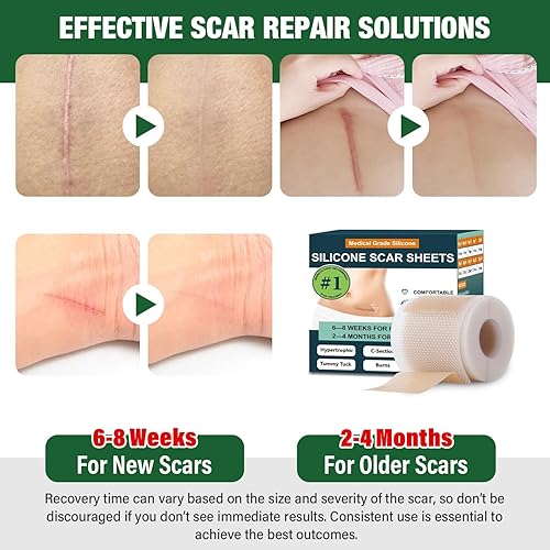 Miniatura 2 de Hojas de silicona para cicatrices, cinta de silicona para cicatrices, láminas de silicona para cicatrices quirúrgicas, eliminación de golpes