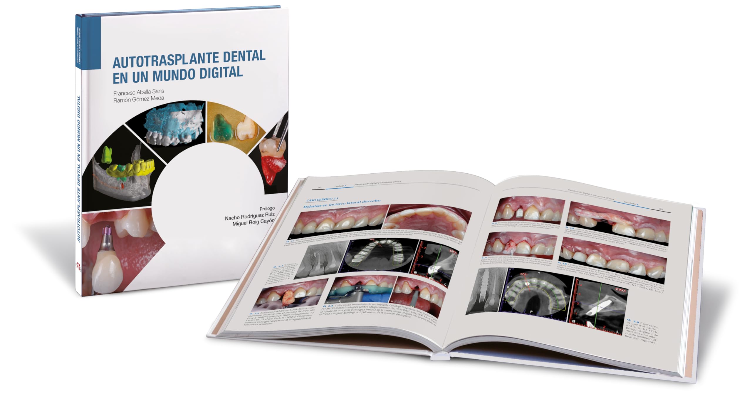 Autotrasplante dental en un mundo digital