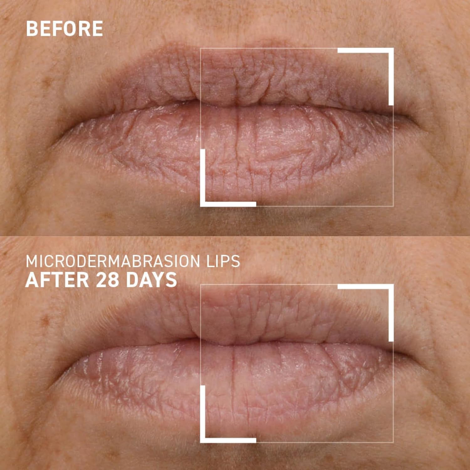 Dr. Brandt Microdermabrasion Smoothing Lip Exfoliator - Polishes & Conditions Dry, Flaky Lips to Renew Skin + Prepare for Color Application - 0.35 oz