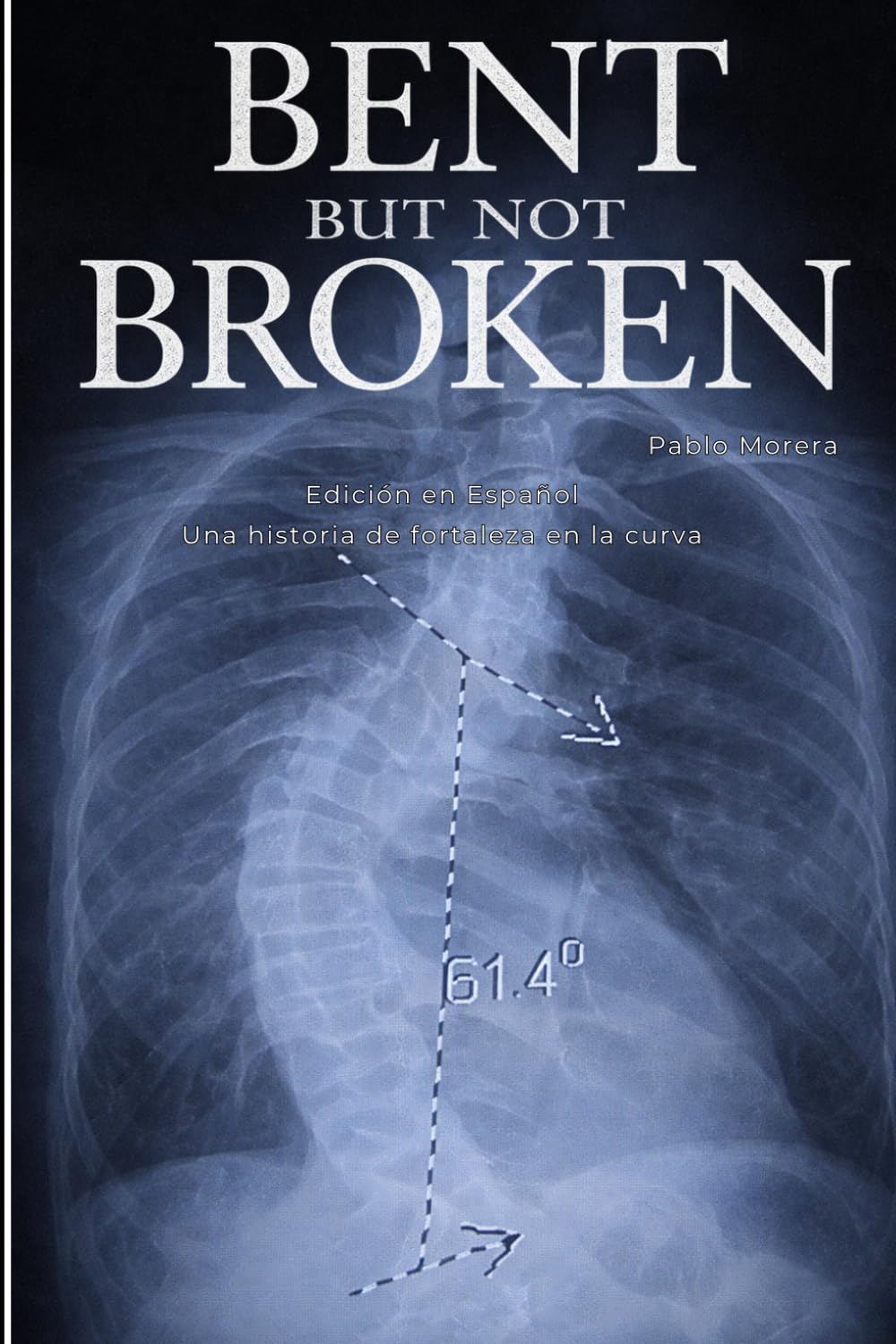 Bent But Not Broken: A Story of Strength in the Curve – Edición en Español: Una historia de fortaleza en la curva
