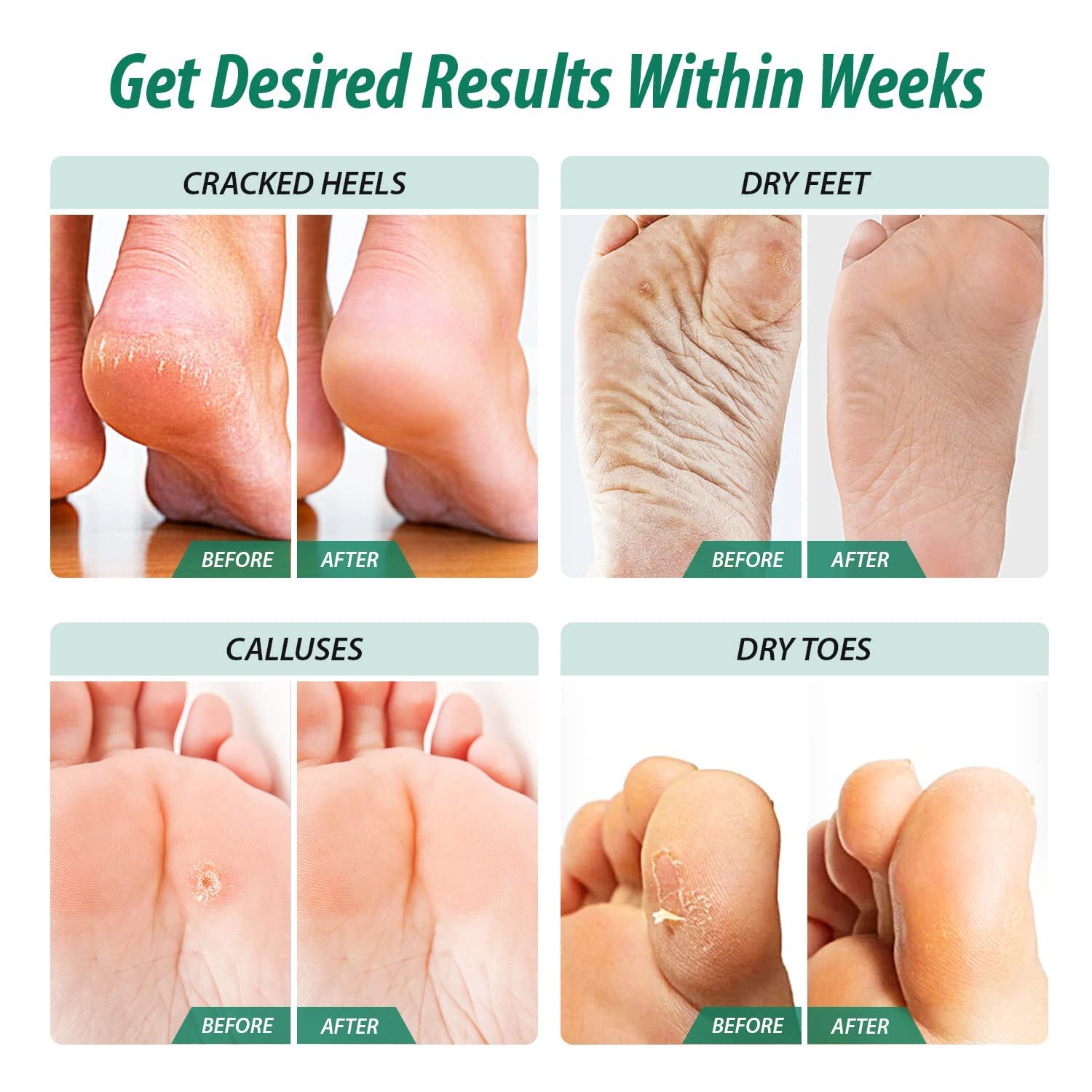 Tea Tree Oil Foot Soak With Epsom Salt - Made in USA - For Foot Odor, Toenail Fungus, Athletes Foot, Softens Calluses & Soothes Sore Tired Feet, Pedicure Spa at Home - 16oz : Beauty & Personal Care