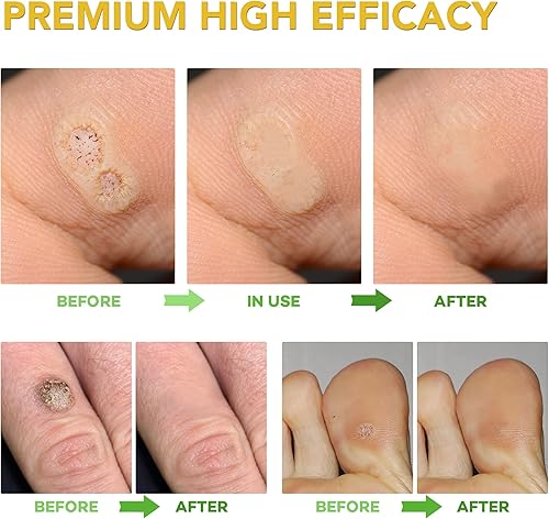 Miniatura 2 de Samsali Removedor de verrugas paquete de 24 tratamientos de eliminación de verrugas altamente potentes removedor de verrugas de alta eficacia para