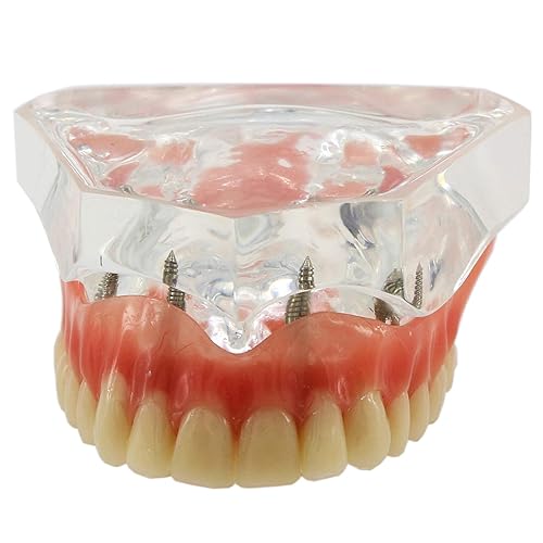 Modelo de sobredentadura dental con 4 implantes para enseñar a estudiar el modo de demostración de la práctica dental (CLEAR)