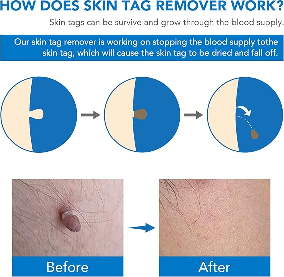 Skin Tag Removal, Effectively and Painless Skin Mole Tag Remover Set-Safe and Easy Remove Small to Large (2mm-8mm) Sized Skin Tags-Tags Fall Off Remover Kit at Home