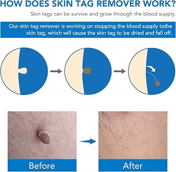Skin Tag Removal, Effectively and Painless Skin Mole Tag Remover Set-Safe and Easy Remove Small to Large (2mm-8mm) Sized Skin Tags-Tags Fall Off Remover Kit at Home