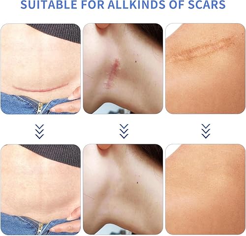 Miniatura 3 de Hojas de silicona para cicatrices, cinta de cicatriz de silicona, cinta para cicatrices quirúrgicas, tiras de silicona para eliminación de