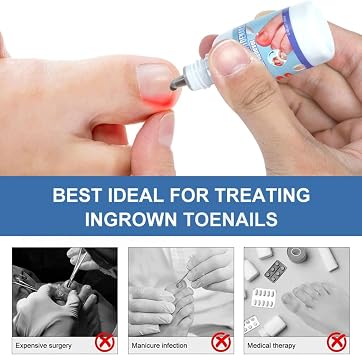 Ingrown Toenail Treatment Extra Strong | Nail Care Solution for Ingrown Toenails | Soften Thick Nails and Support Healthy Nail Growth 20ml