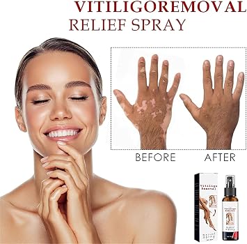 ATTDX Vitiligoremoval Relief Spray, Vitiligo Removal Relief Spray, Vitiligo Skin Repair Spray, Vitiligo Treatment Spray, White Spot Spray, Vitiligo Care Spray for Skin Care (1PC)