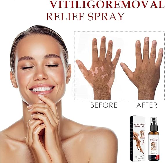 ATTDX Vitiligoremoval Relief Spray, Vitiligo Removal Relief Spray, Vitiligo Skin Repair Spray, Vitiligo Treatment Spray, White Spot Spray, Vitiligo Care Spray for Skin Care (1PC)