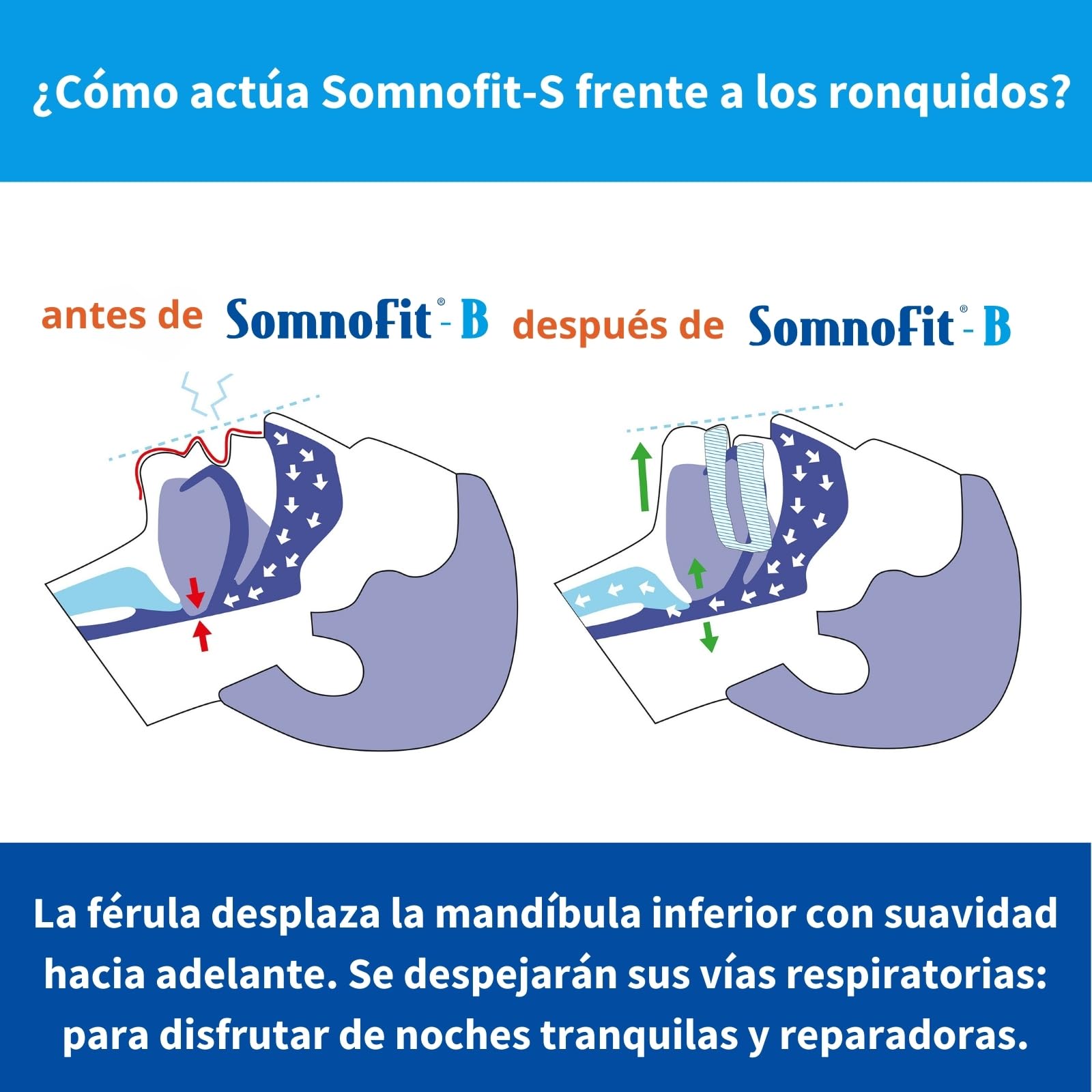 SomnoFit -B Férula para ronquidos para mandíbula grande, muy cómodo de llevar, del fabricante suizo premium