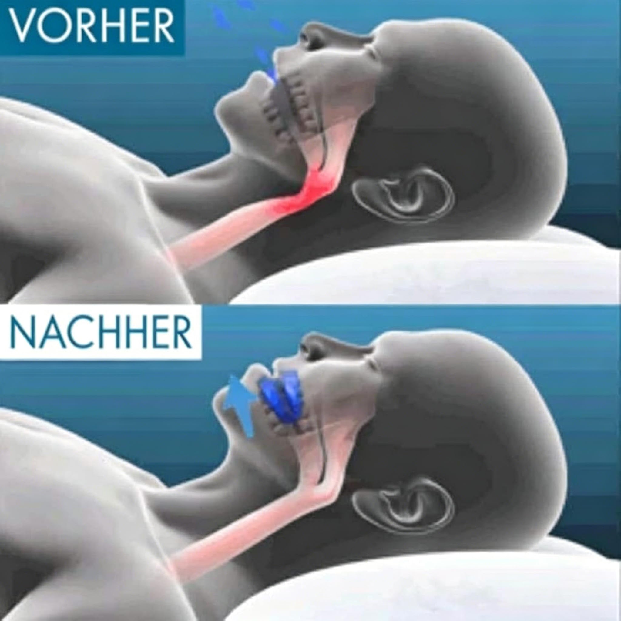 Levora Pro Schnarchschiene - anti Schnarch Schiene, Zahnschiene Gegen Schnarchen & Zähneknirschen, Schnarchstopper, Mundstück, Wiederverwendbare Bessere Atmung Schlafhilfe (×1)