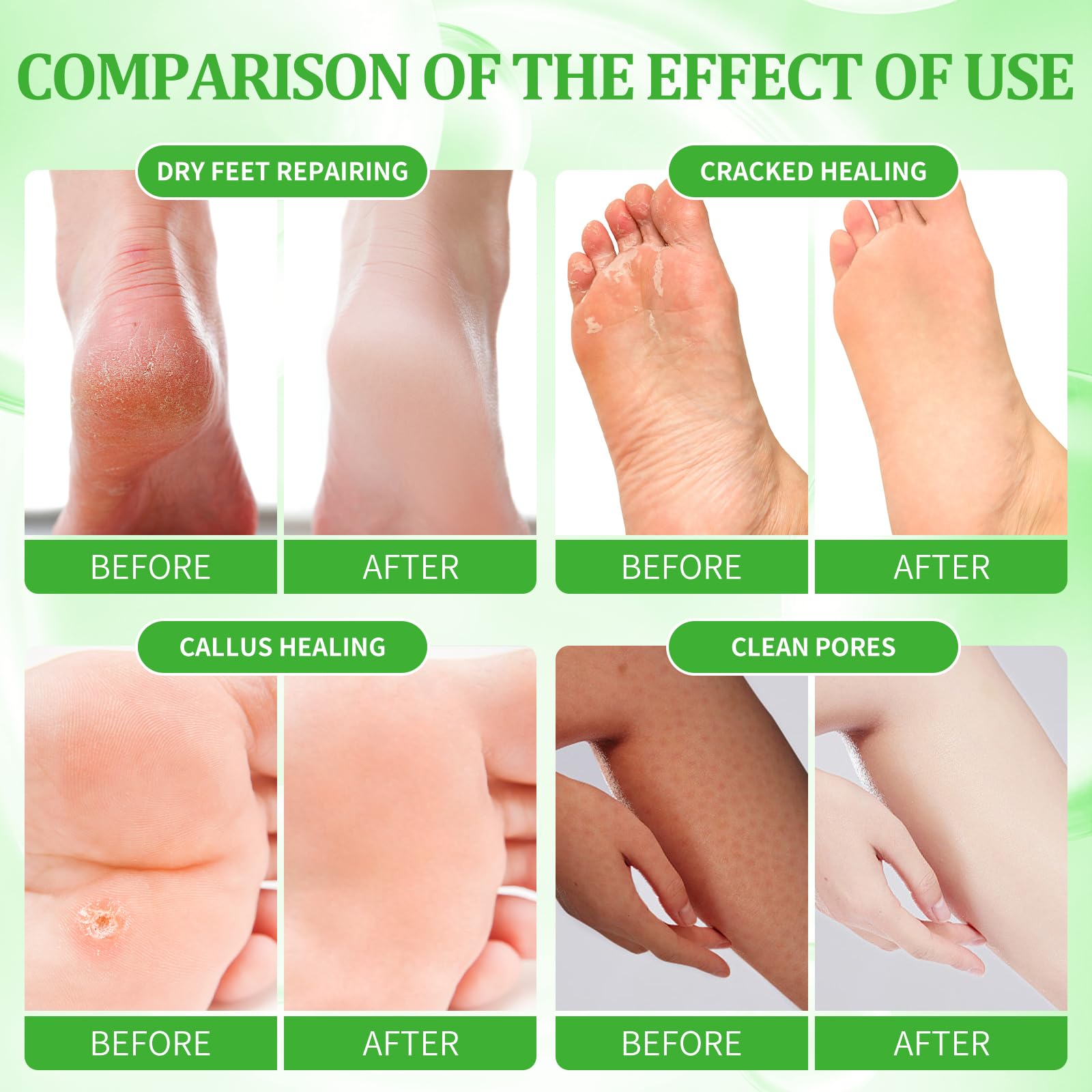 Kit de trempage des pieds : sel bulle, gommage au sucre, masque de massage, lotion de massage dans une boîte, kit spa 4 étapes pour pieds secs, adoucit les callosités, pieds fatigués (3