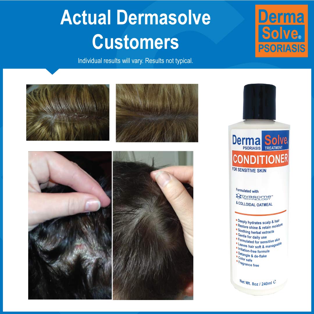 Buy Scalp Psoriasis & Dandruff Shampoo and Conditioner by DermaSolve