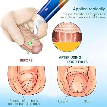 Phimosis Cream for Adults, Phimosis Foreskin Correction Gel, 20g (2Pcs)