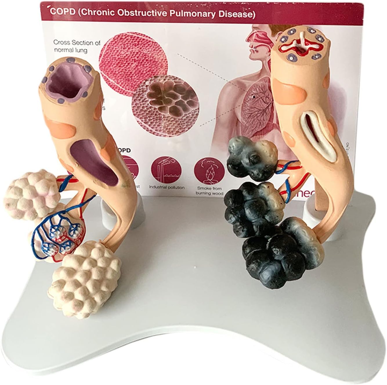 Human Smoking Lung Health Alveolar Model, Smokers Lung Model Healthy Lung Model, with Pathological Features And Accurate Anatomy Structure for The Effects Of Smoking On Lung Health