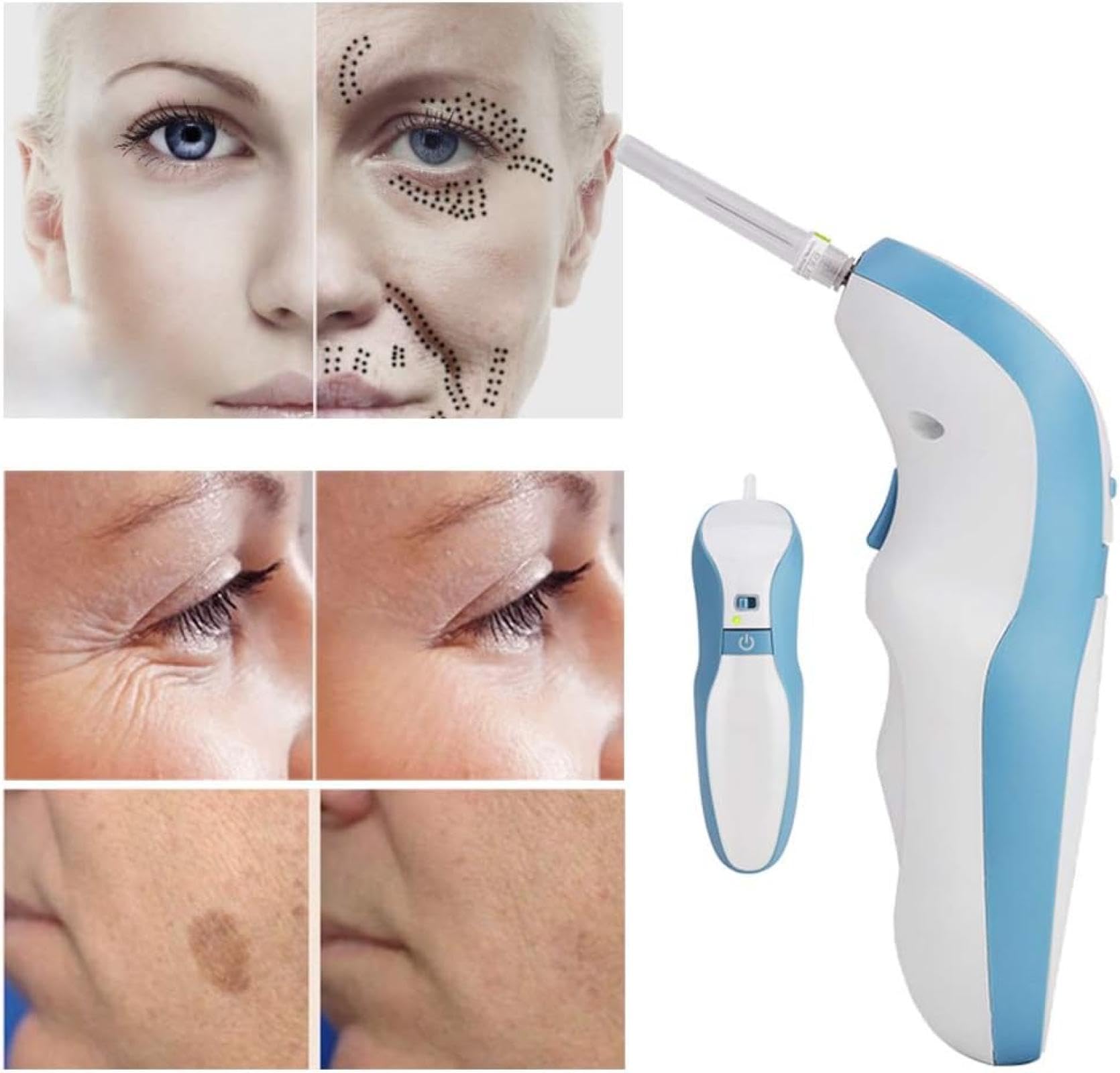 Penna al plasma professionale per la cura della pelle, dispositivo per la rimozione di macchie scure e imperfezioni, bianco e blu