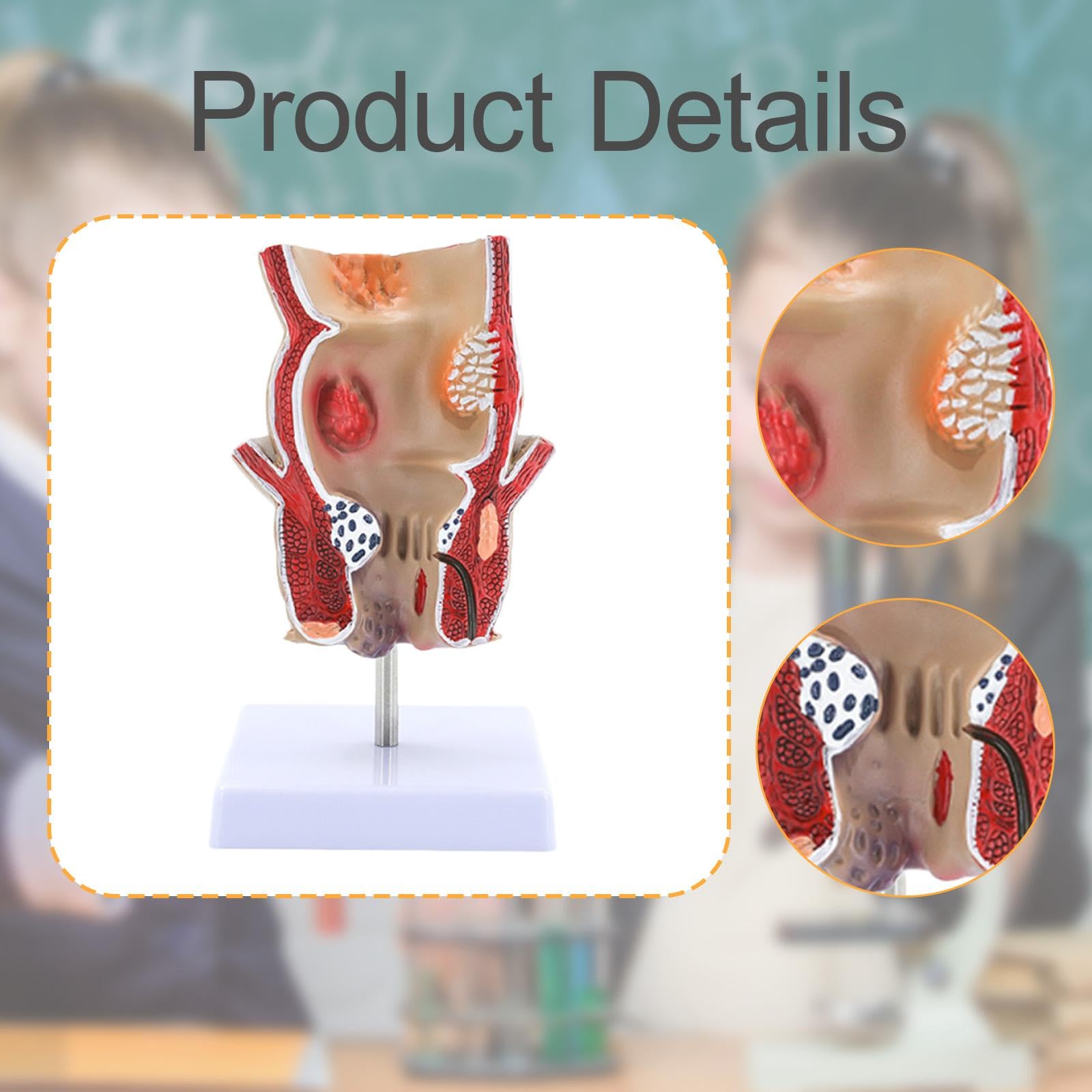 F Fityle Modelo de patología de hemorroides rectales, Material didáctico, Modelo anatómico, Herramienta de exhibición para el Aprendizaje científico.
