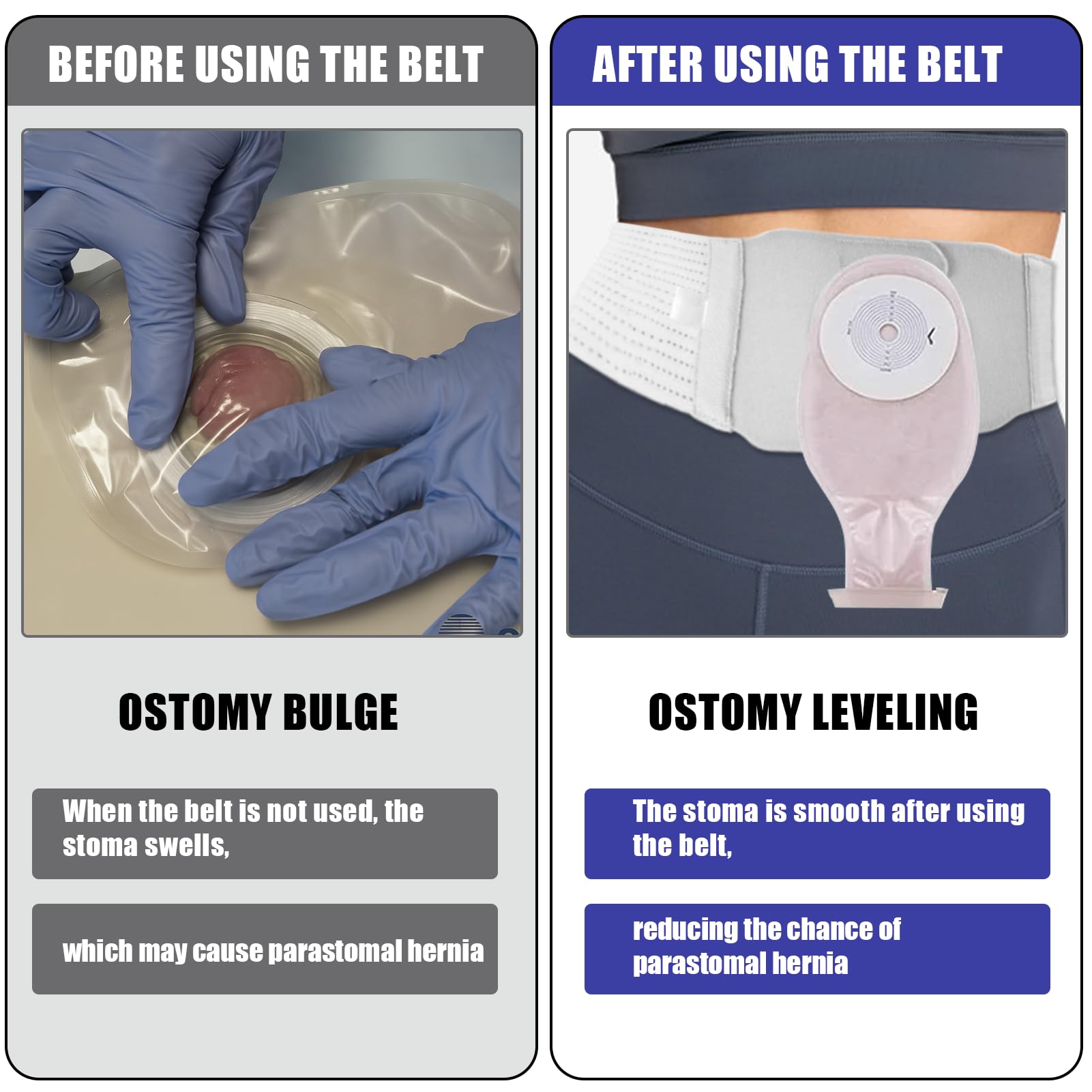 Cintura Stoma, cintura di supporto per stomia regolabile, cintura universale per colostomia e ileostomia, Cintura Per Colostomia, sacca per ileostomia, Forniture Per Stomia (XL)