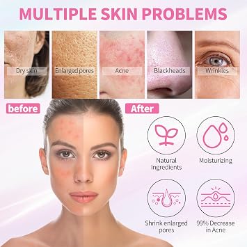 Skin Care Set - 5 Step Skincare with Cleanser, Face Scrub, Clay Mask,Toner & Acne Treatment for Teens and Adults