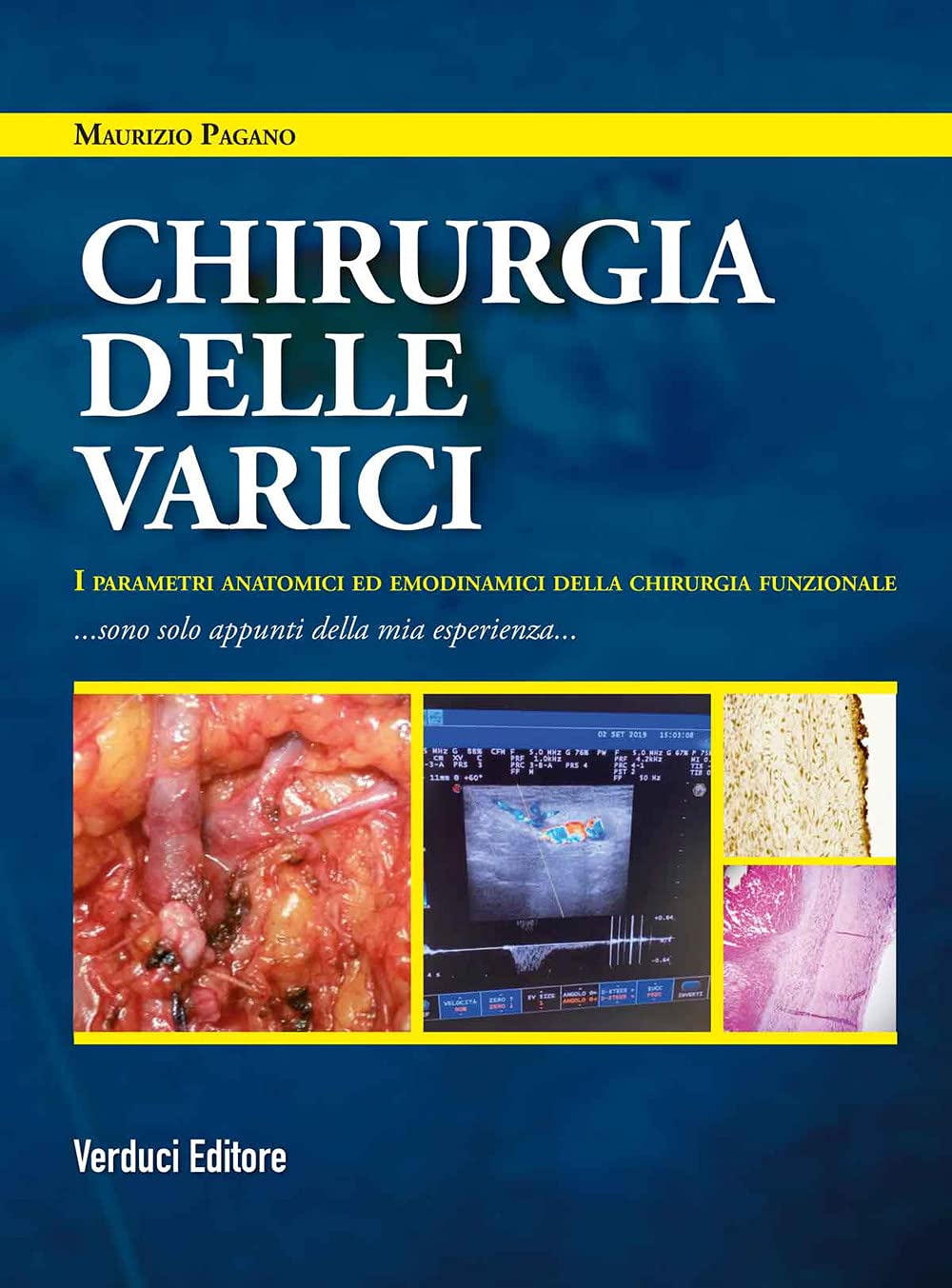 Chirurgia Delle Varici. I Parametri Anatomici Ed Emodinamici Della Chirurgia Funzionale - 4