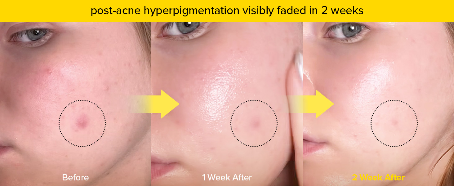 Amazon.com: MIMUMIMU Dark Spot Intensive Ampoule for