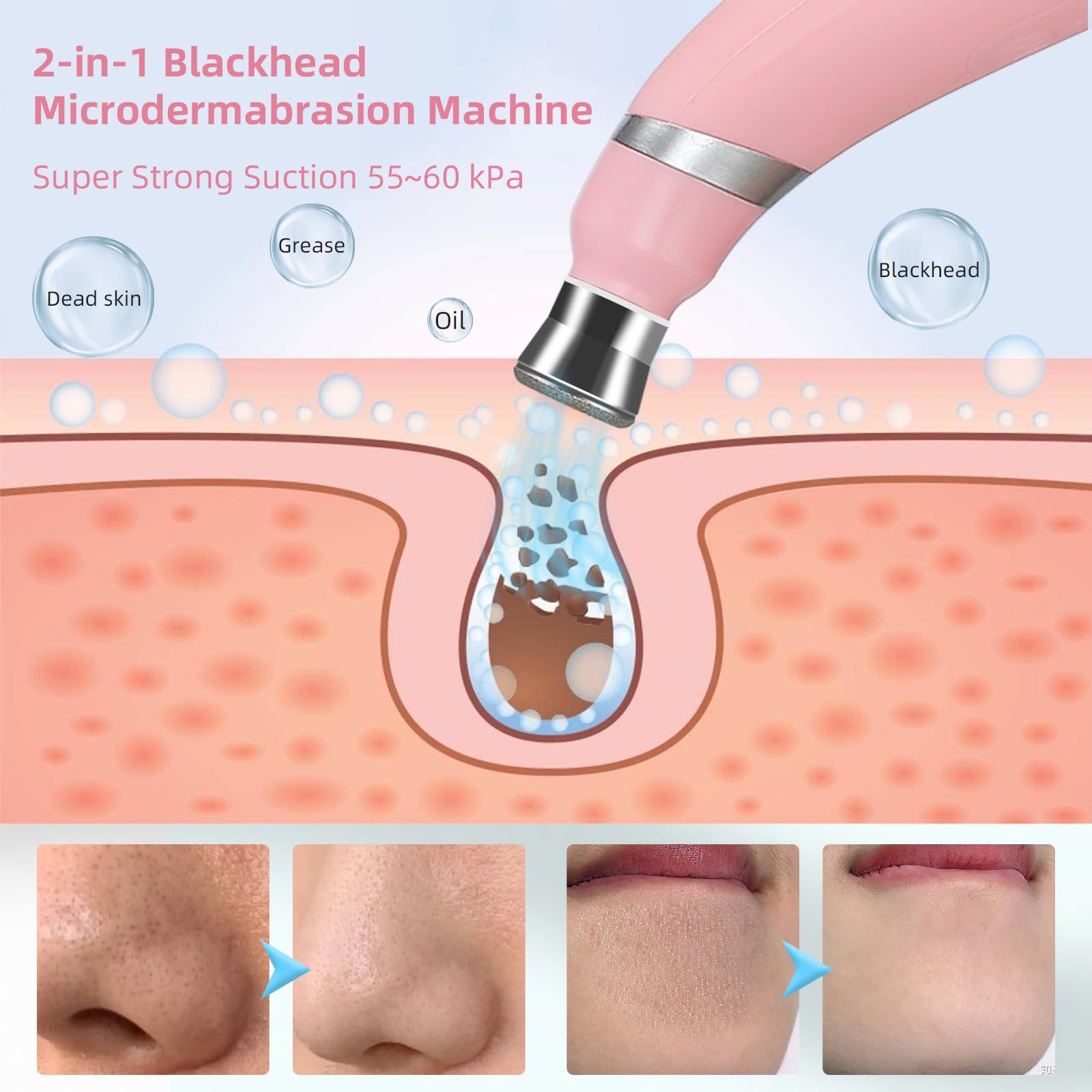 Máquina de microdermoabrasión de diamante, máquina de dermoabrasión de microdermoabrasión de diamante de 3 modos para eliminación de puntos negros, dispositivo de microdermoabrasión portátil 2