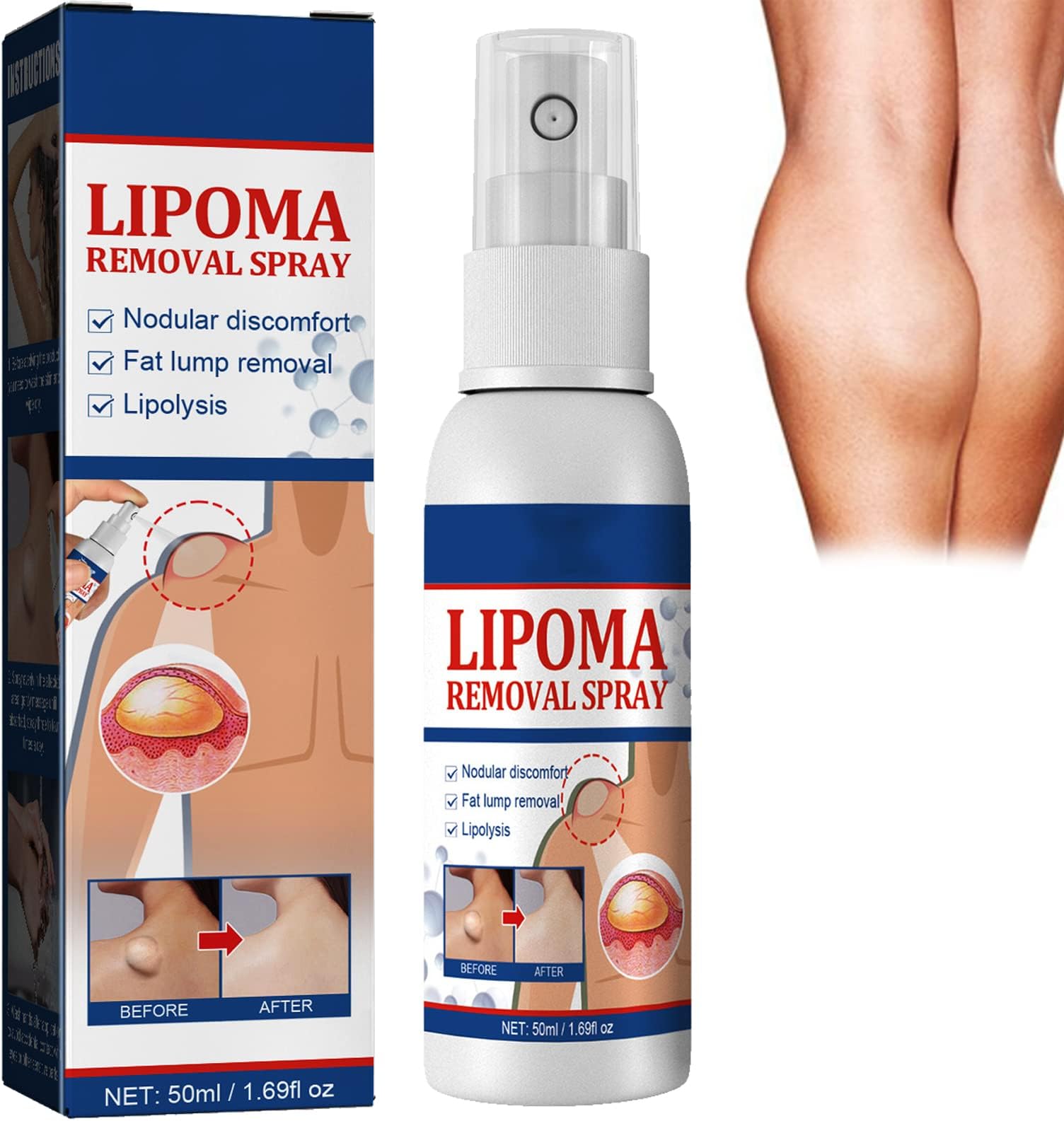 Lipoma Removal Spray,Lipoma Reduction,Instant Lipoma Removal,Lipolysis Lump,Lumpfree Lipoma Removal,Lipoma Removal Treatment,Effectively Relieve Fat Knots,Etc(50Ml)